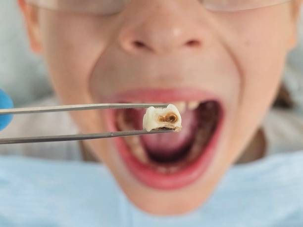 Best Emergency Wisdom Teeth Removal in Whiteville, NC